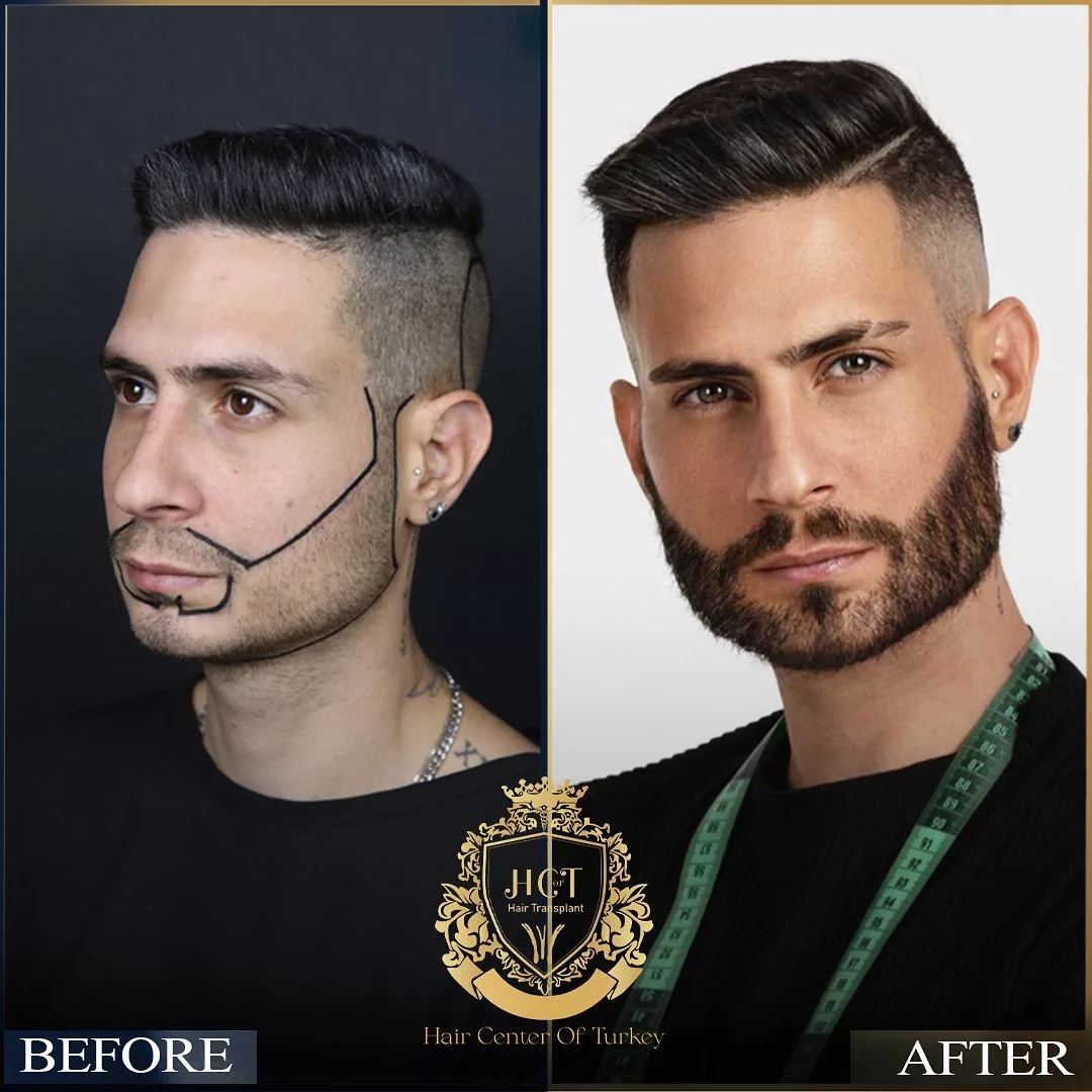 Beard Transplant Before After