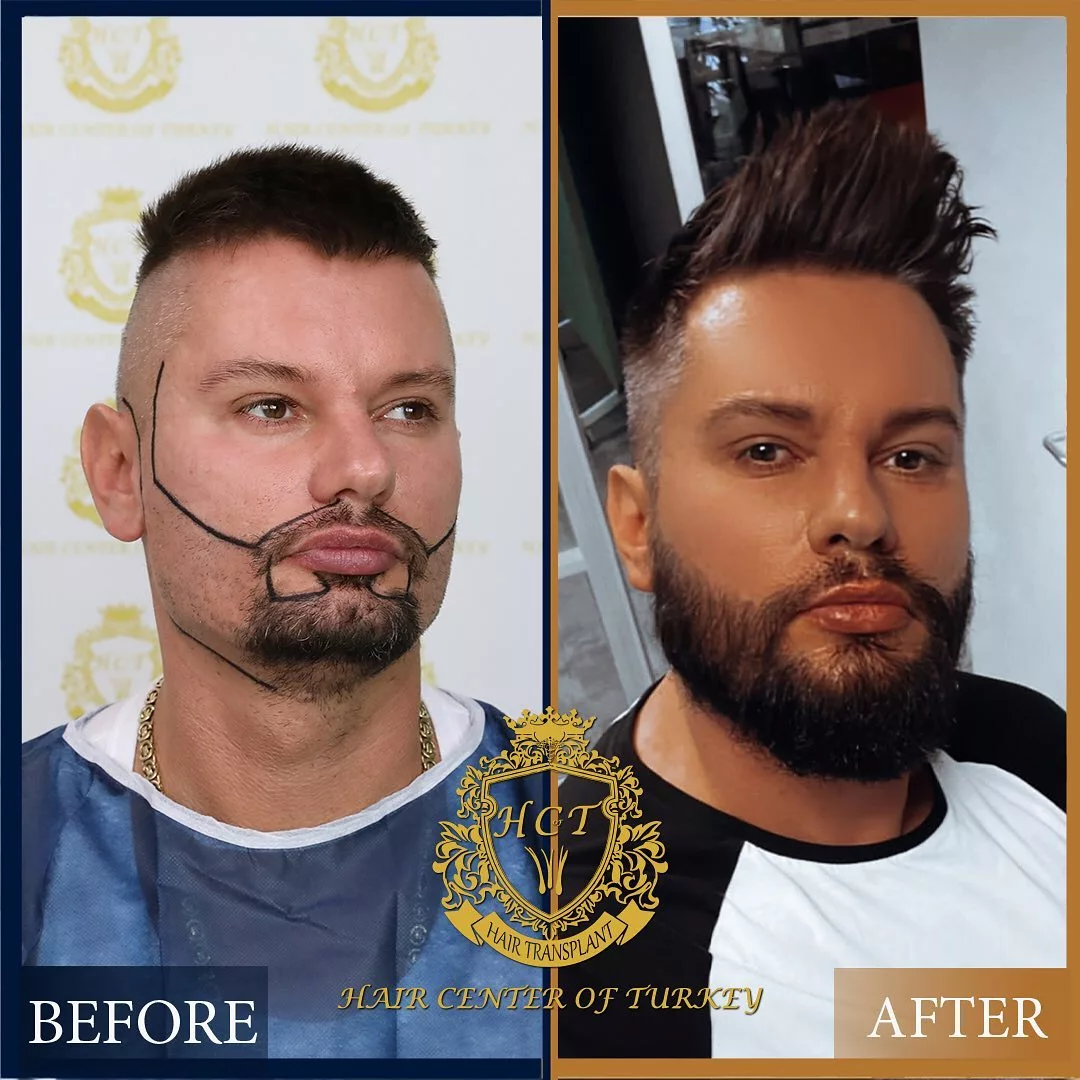 Beard Transplant Before After 5