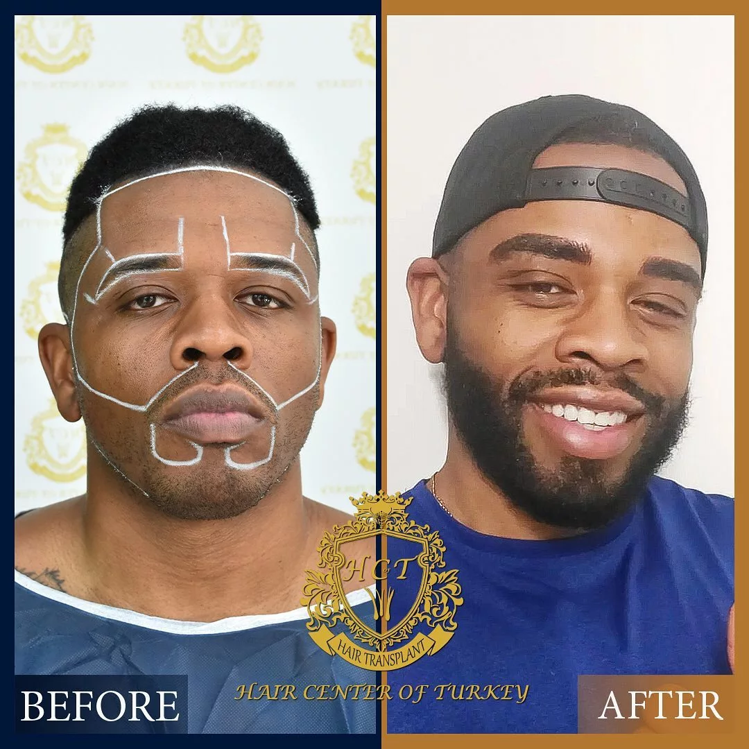 Beard Transplant Before After 6