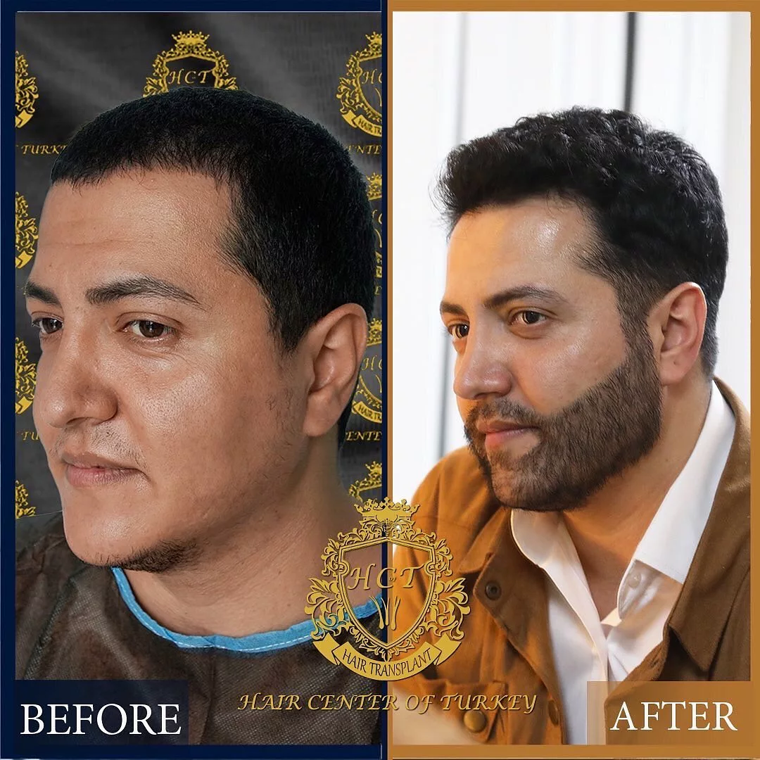 Beard Transplant Before After