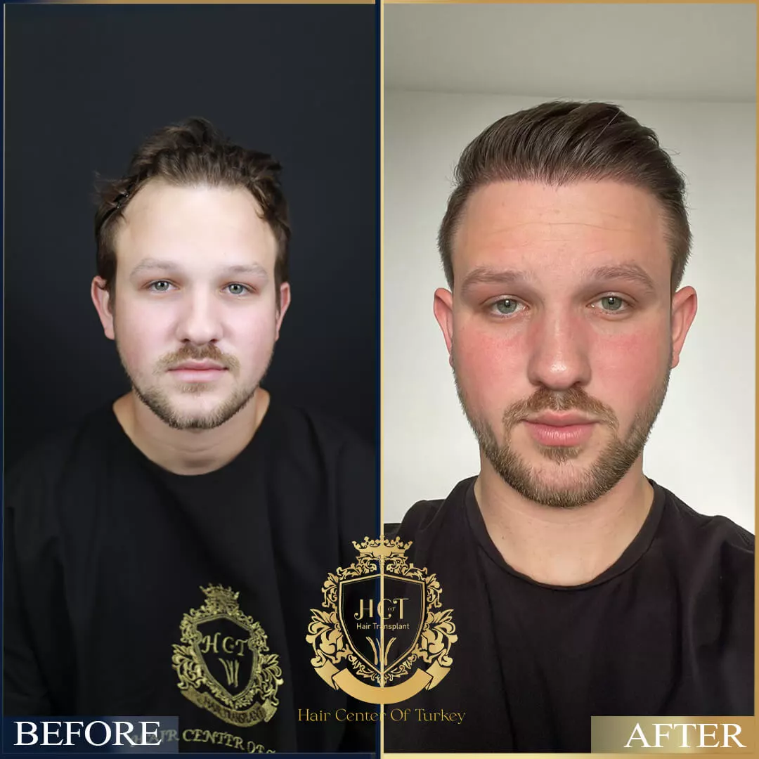 Hair Transplant Before After 11