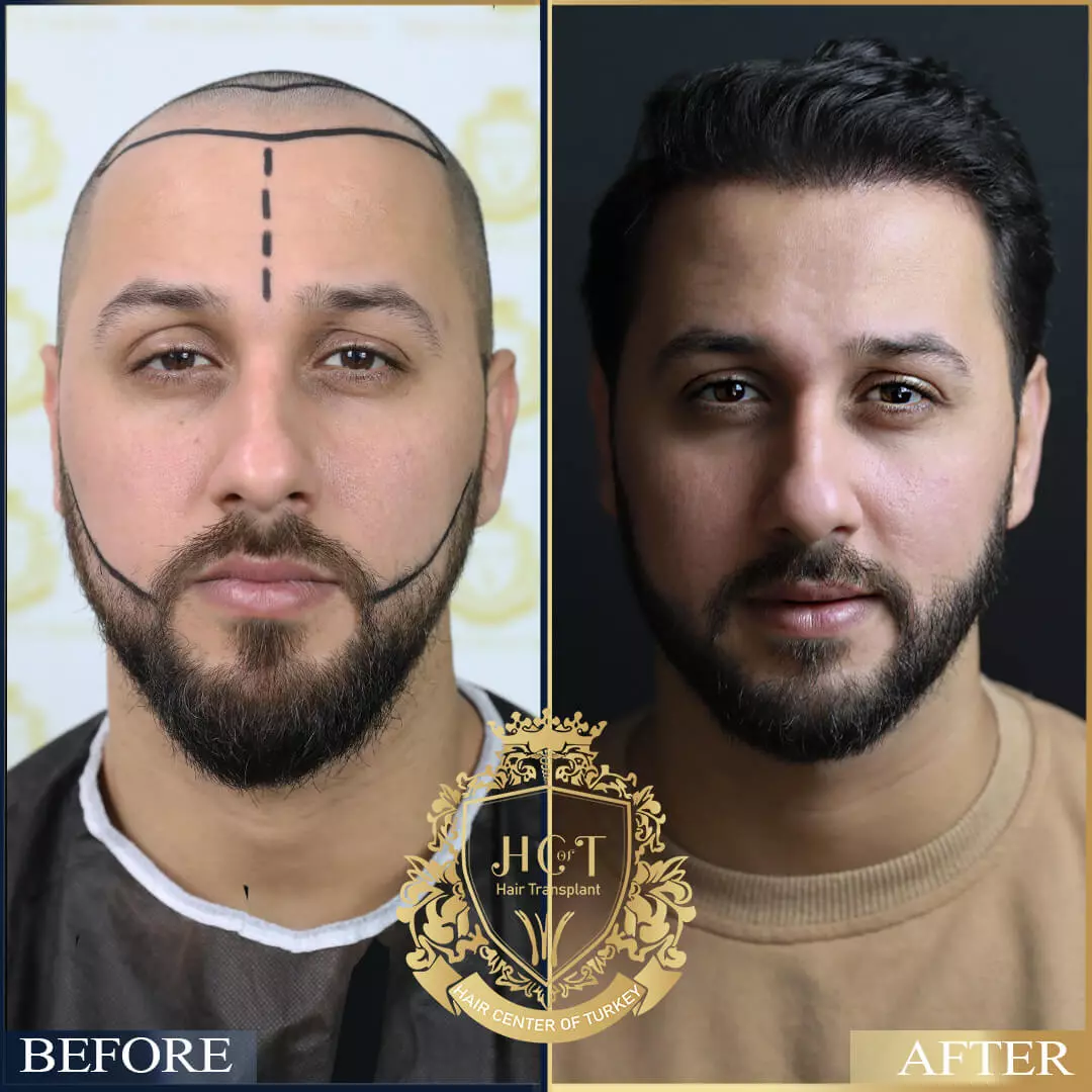Hair Transplant Before After 15