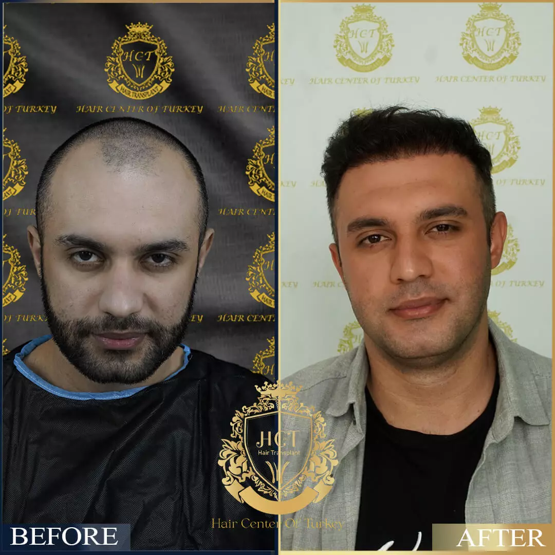 Hair Transplant Before After 18