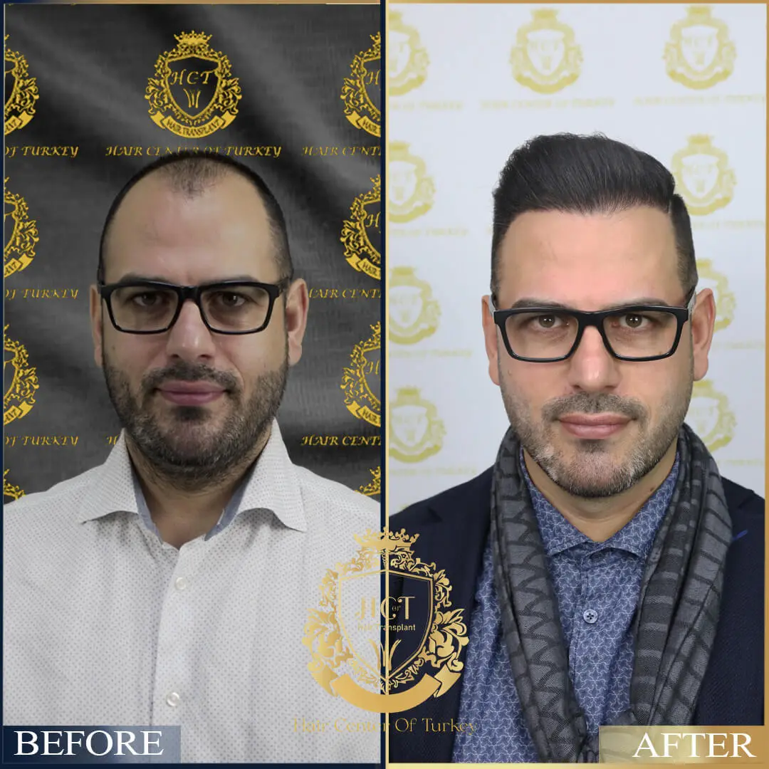 Hair Transplant Before After 21