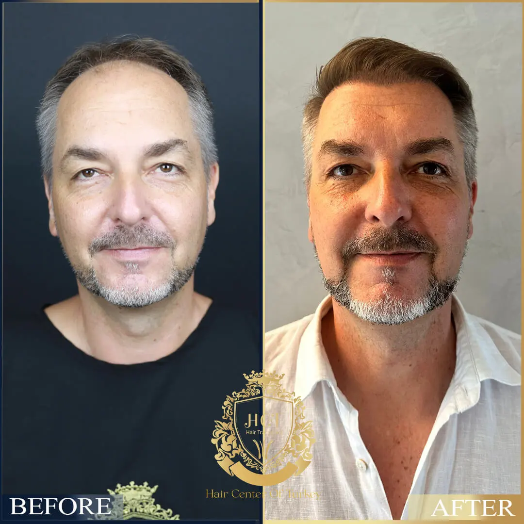 Hair Transplant Before After 30