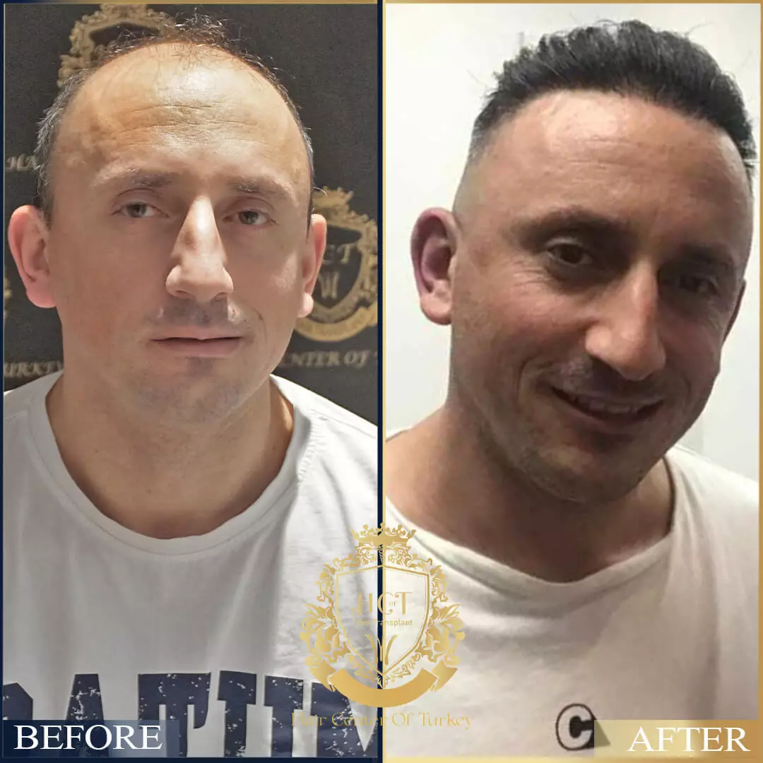 Hair Transplant Before After 7