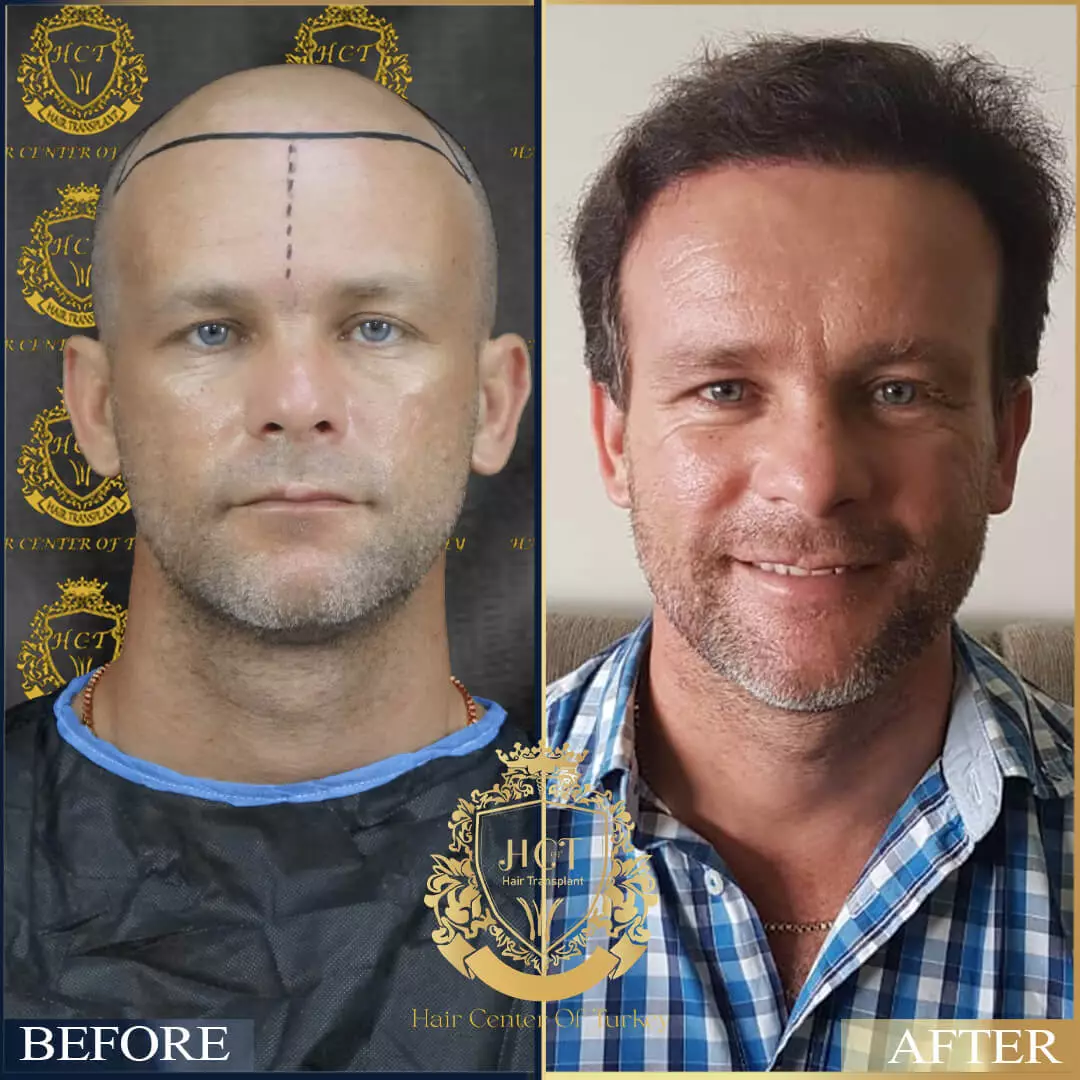 Hair Transplant Before After 9