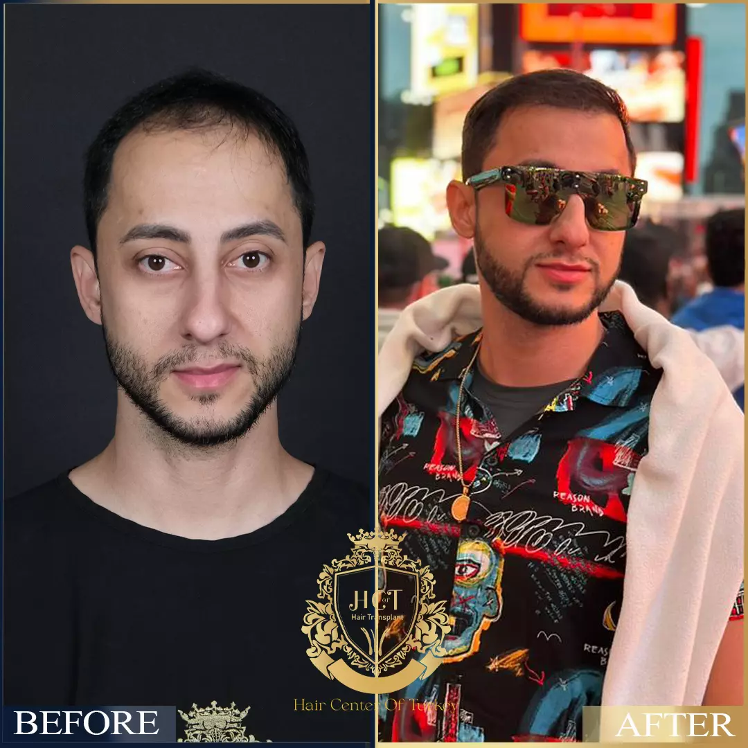 Hair Transplant Before After 91