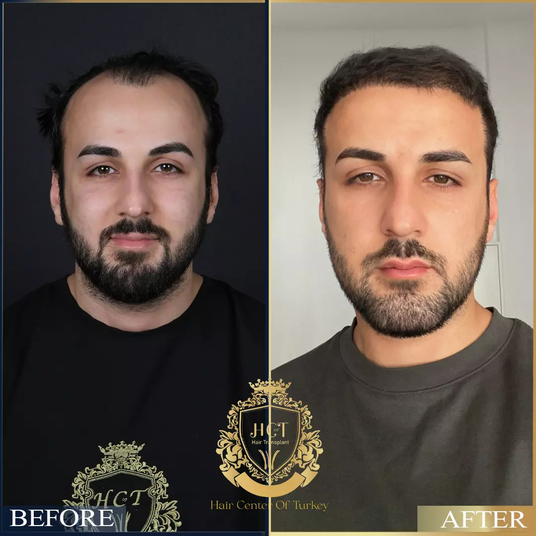 Hair Transplant Before After 92
