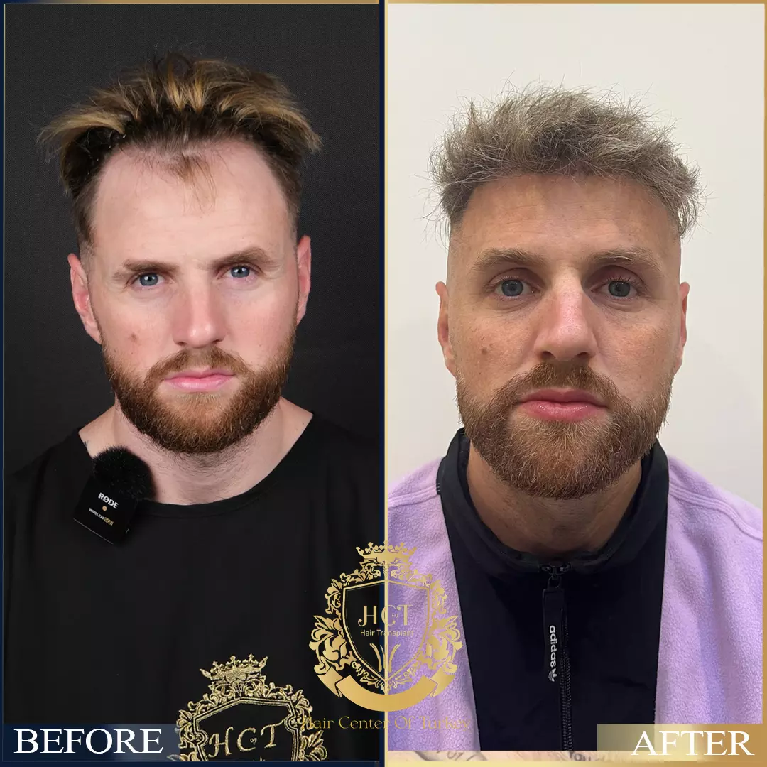 Hair Transplant Before After 94