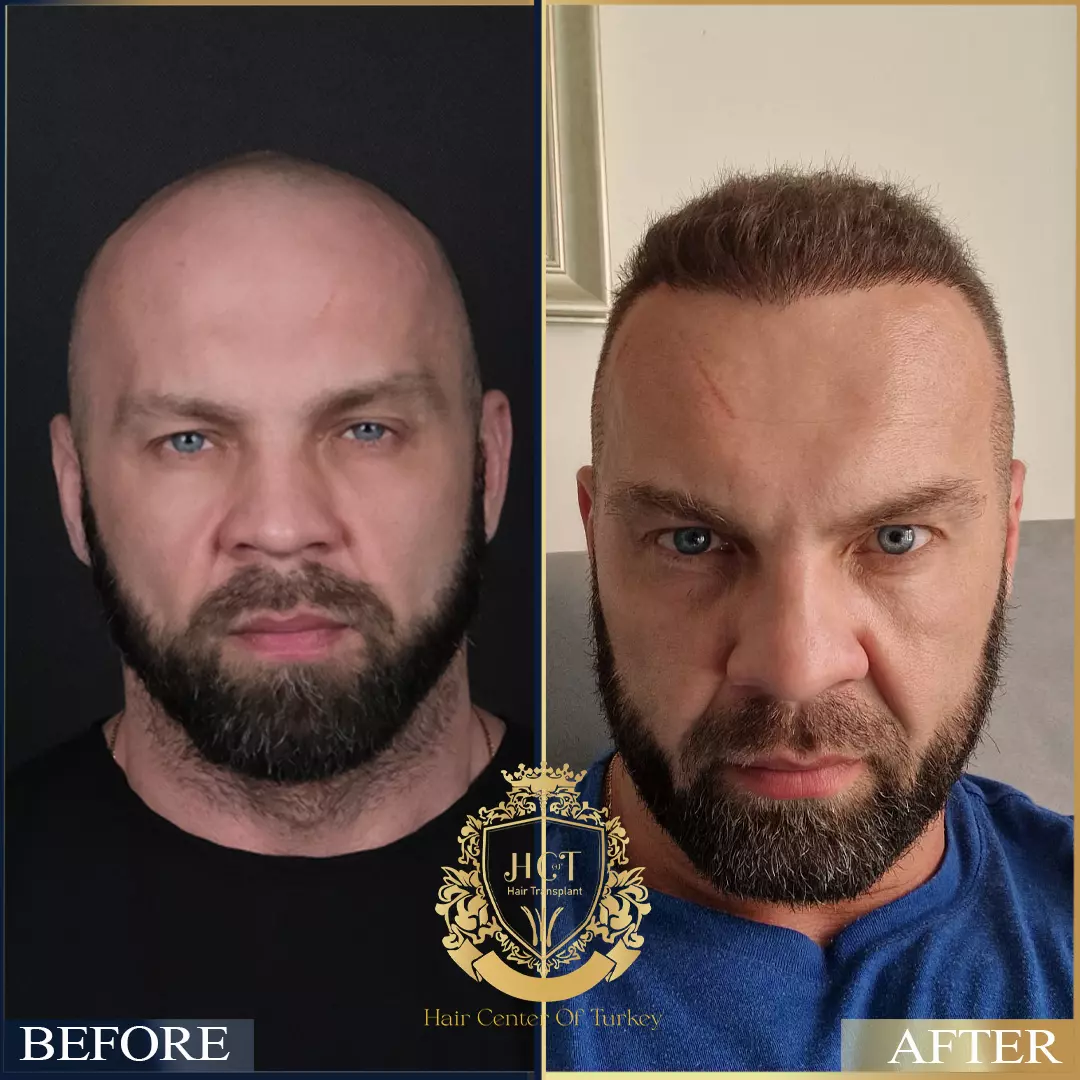 Hair Transplant Before After 95