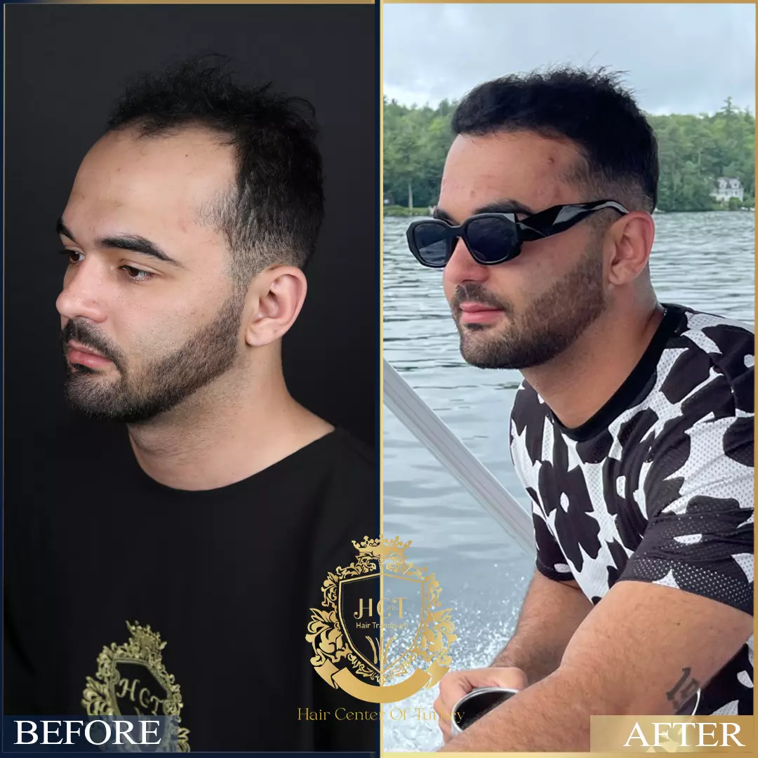 Hair Transplant Before After 98