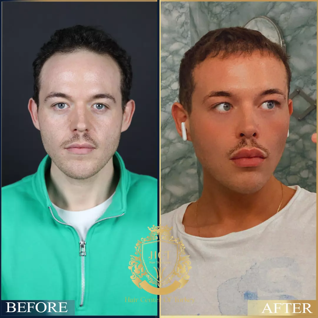 Hair Transplant Before After 99
