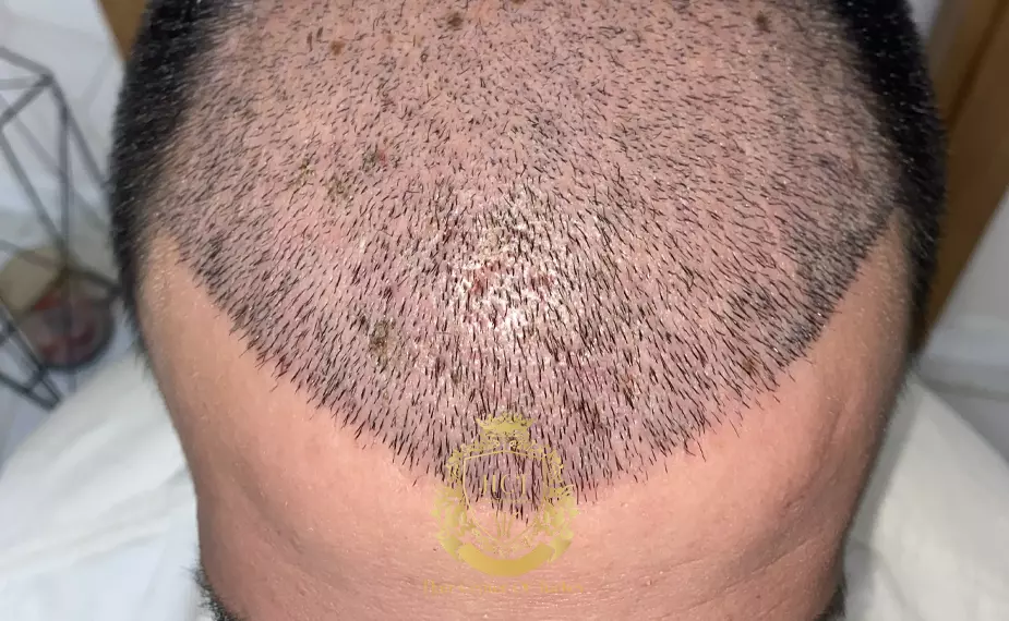 hair transplant shell loss