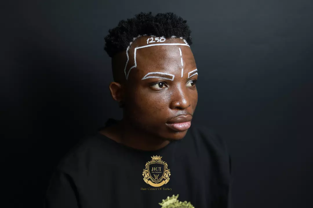 afro eyebrow transplant