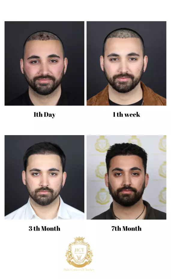 hair transplant results steps