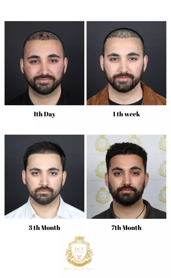 recovery process after hair transplant