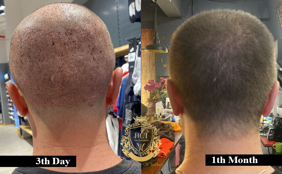 hair transplant recovery process