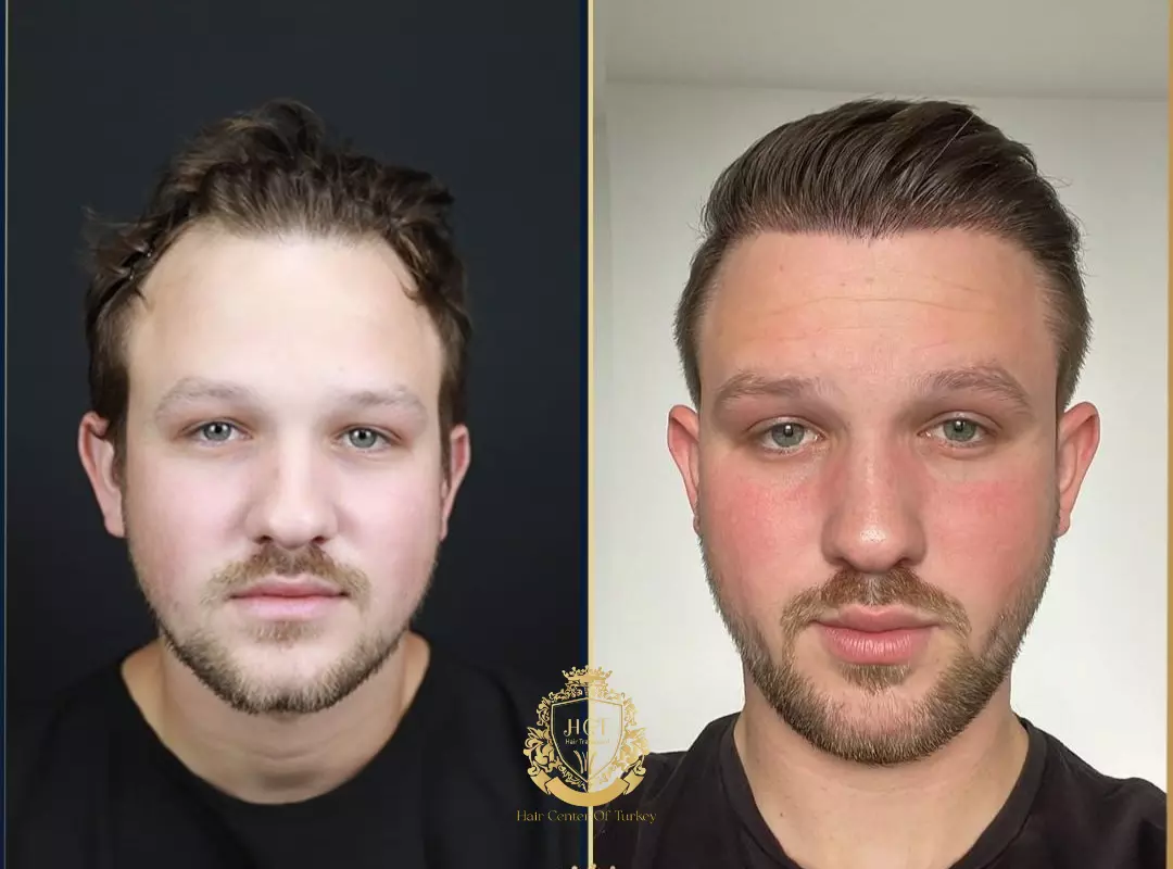Hair Transplant Before After 2