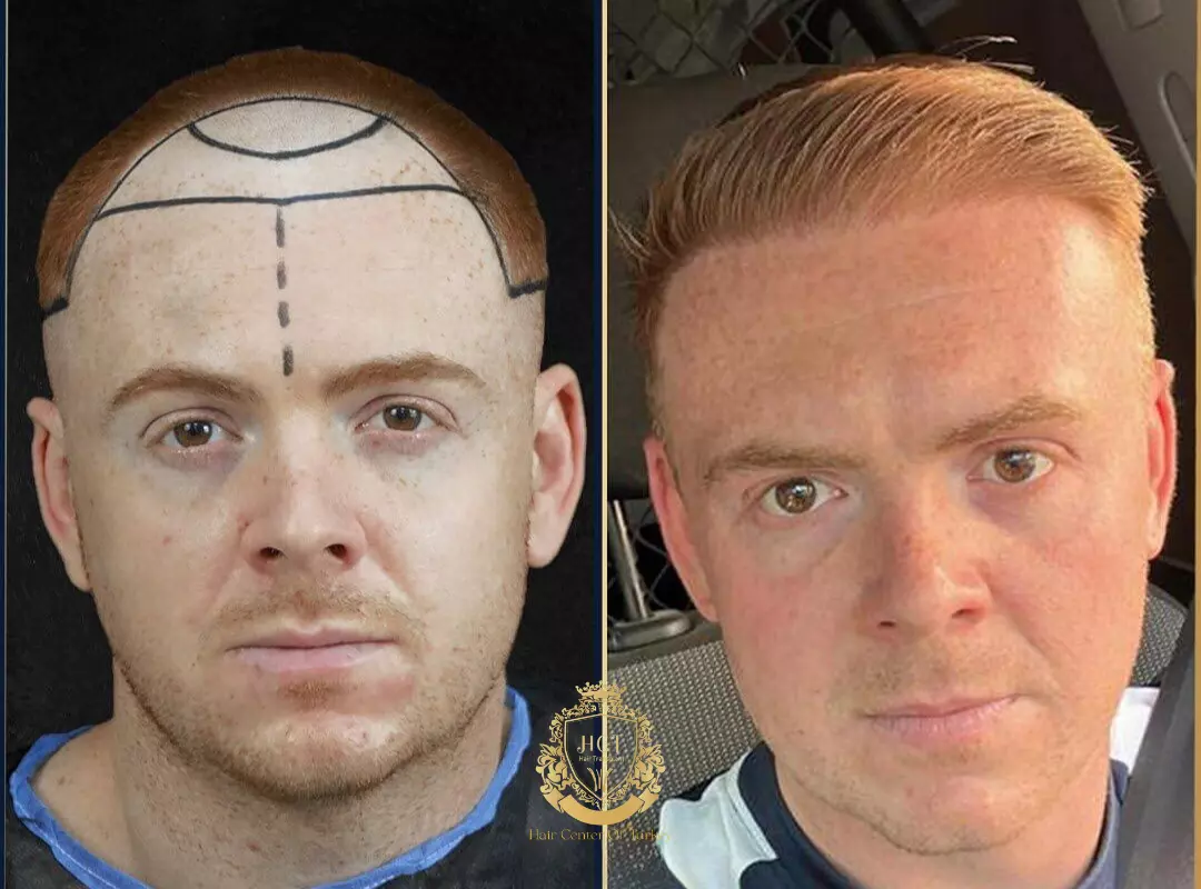 Hair Transplant Before After 3