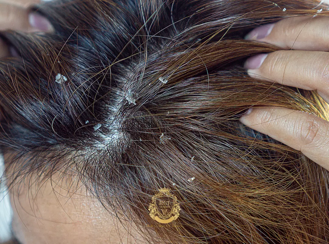 Those with acute scalp problems
