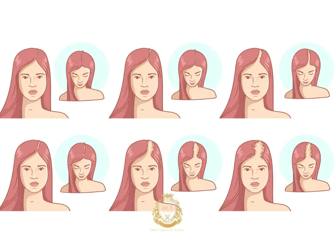 Types of Hair Loss in Women