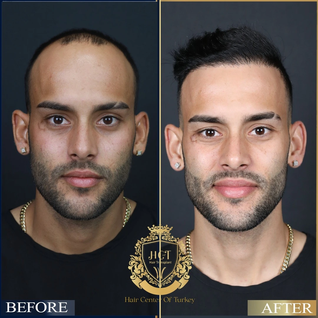 hair transplant before after