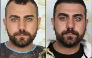 hair transplant before after