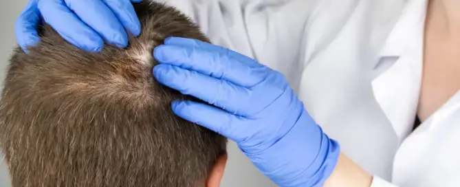 saçkıran alopesi areata nedir