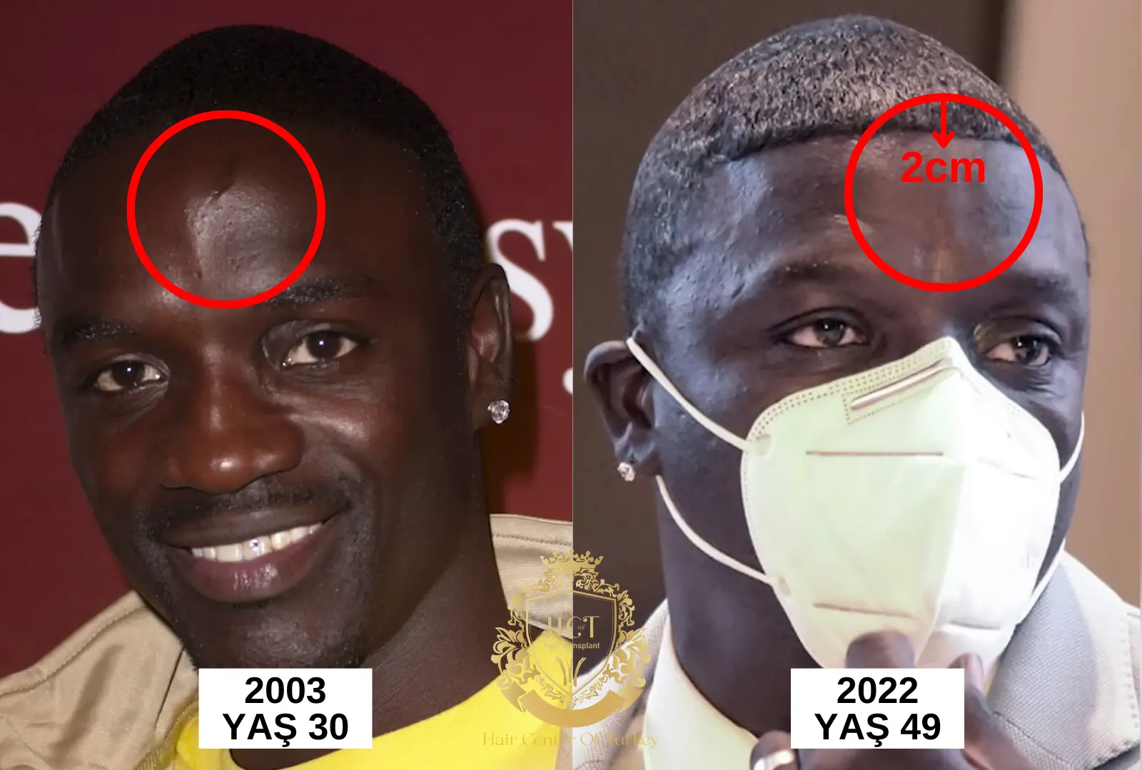 akon hair transplant