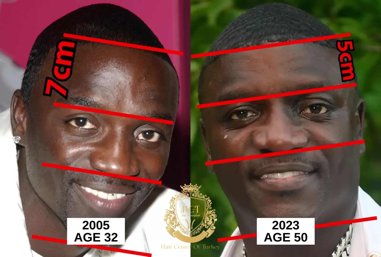 akon hair transplant