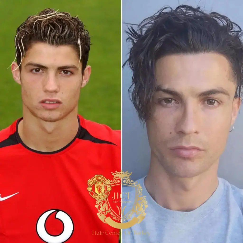 cristiano ronaldo hair transplant featured