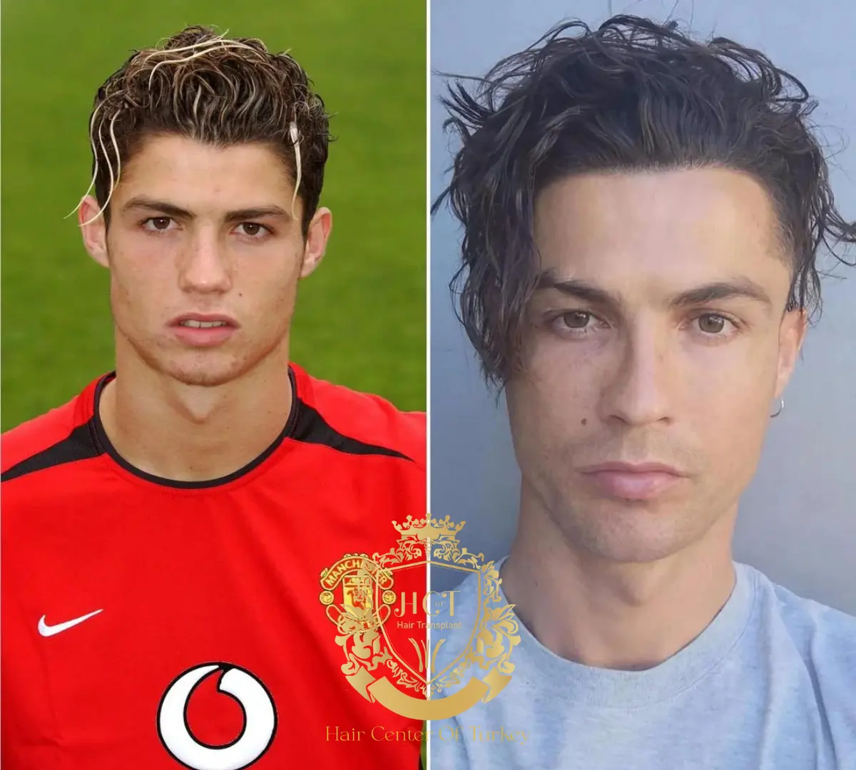 cristiano ronaldo hair transplant 1