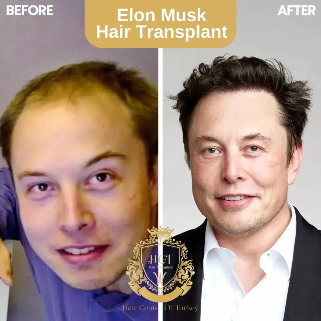 Elon Musk Hair Transplant