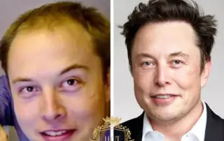 Elon Musk Hair Transplant