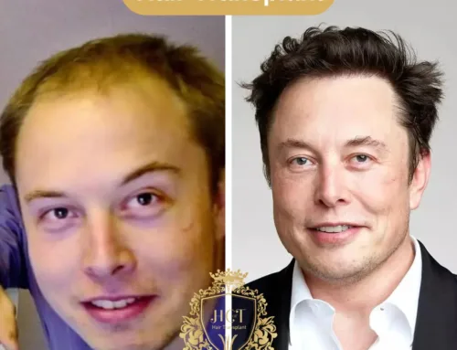 Elon Musk Haartransplantatie | Beroemdheden Haartransplantaties
