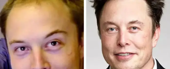 Elon Musk Hair Transplant