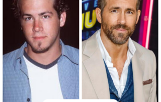 Ryan Reynolds Hair Transplant