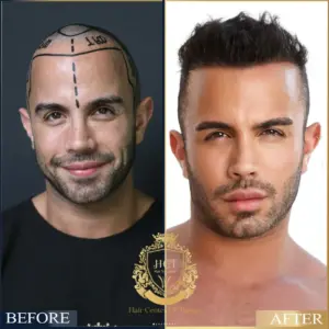 hair transplant before after