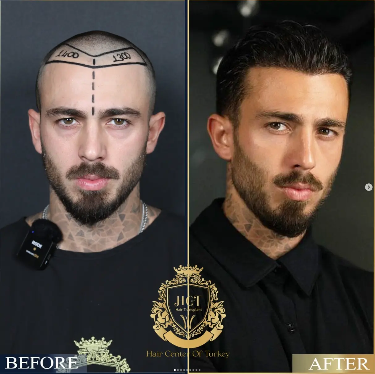 hair transplant before after 1