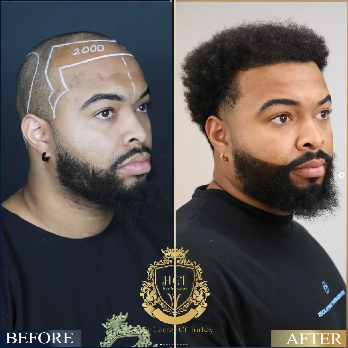 hair transplant before after 3