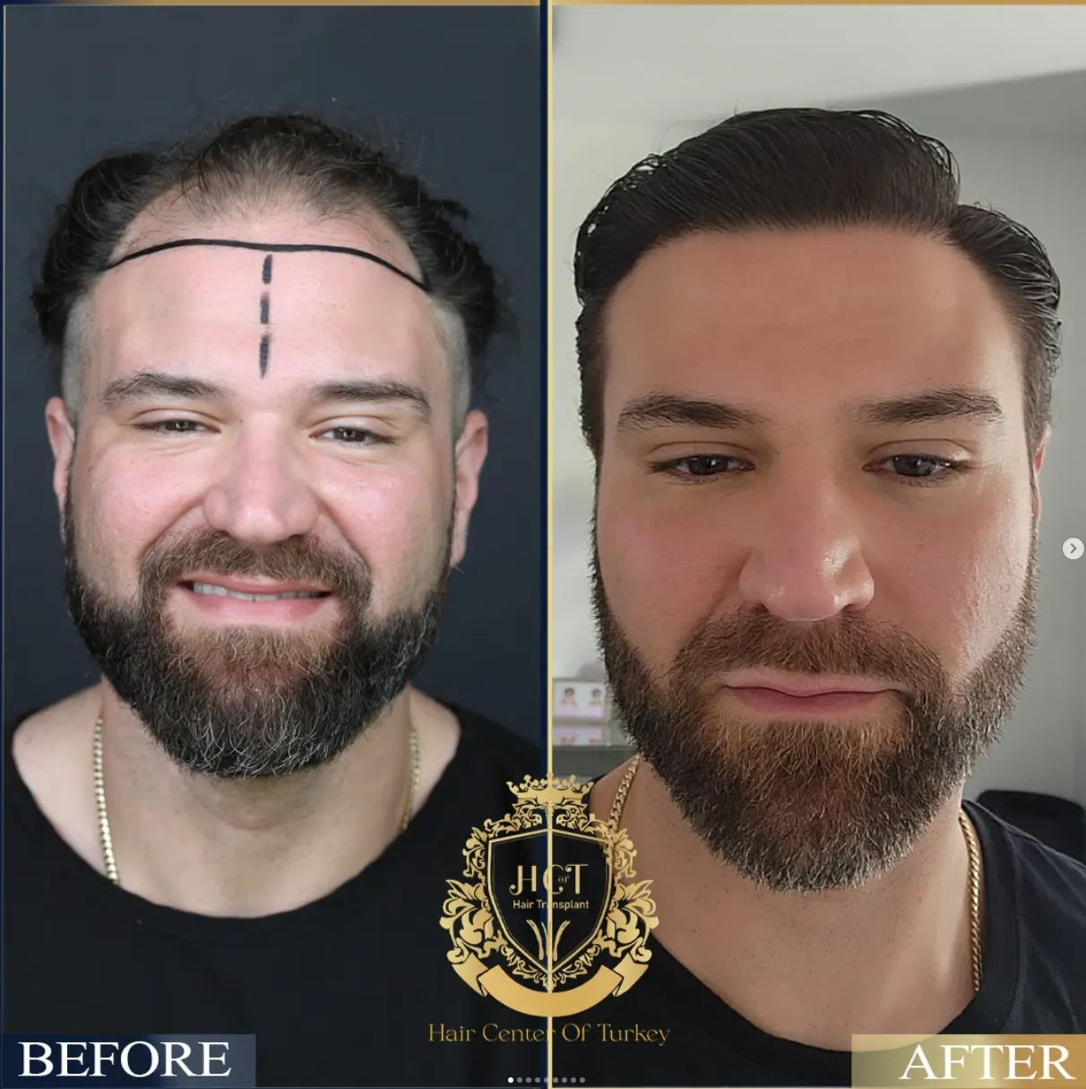 hair transplant before after 4