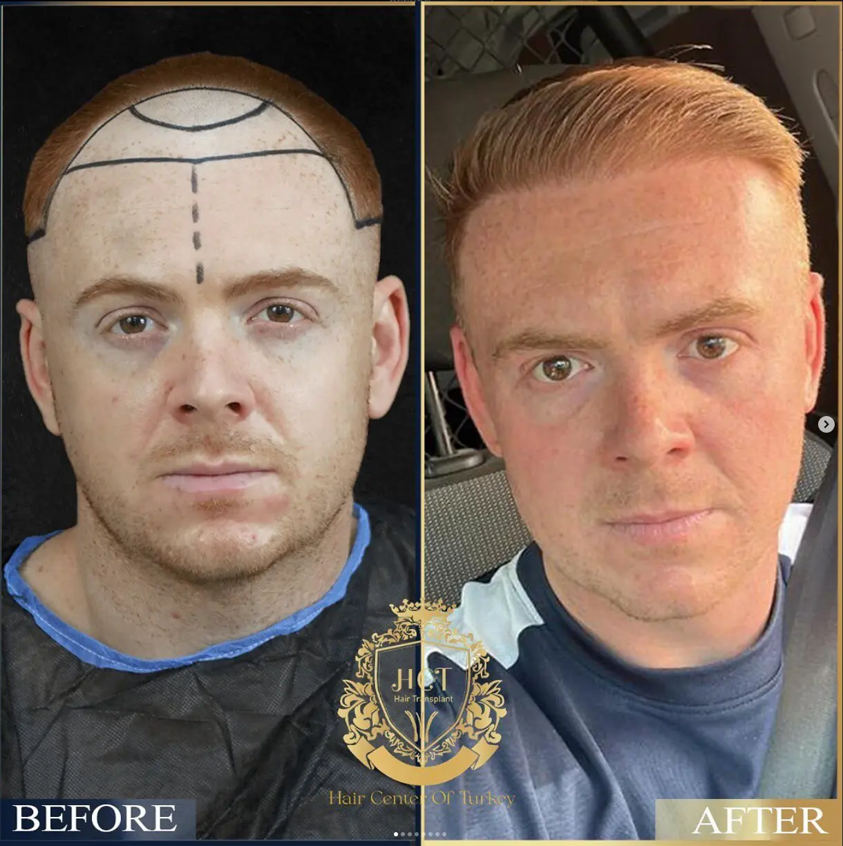 hair transplant before after 6