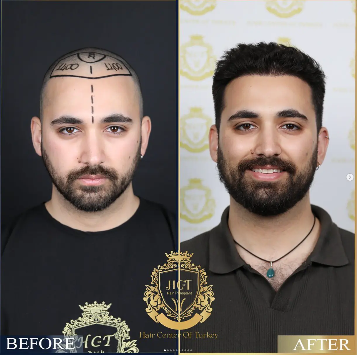 hair transplant before after 7