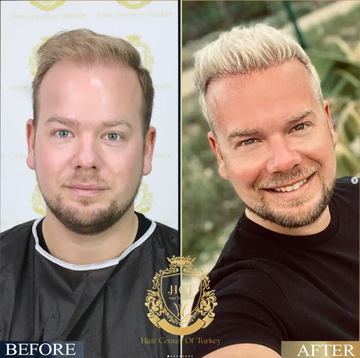 hair transplant before after 8