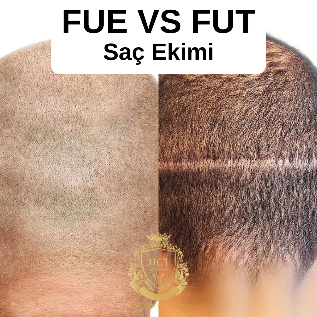 FUE VS FUT Sac Ekimi