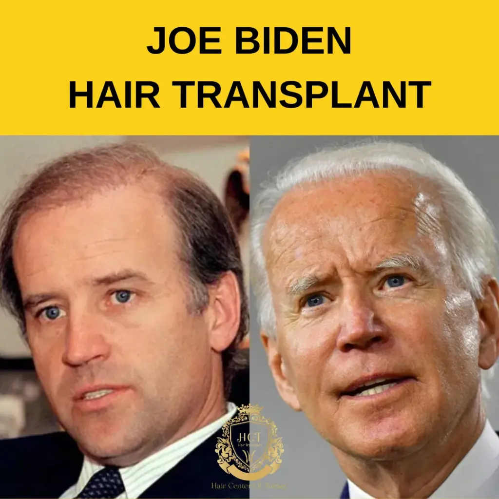 Joe Biden Hair Transplant Featured Image 1