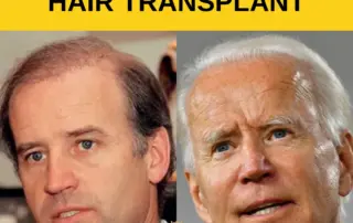 Joe Biden Hair Transplant Featured Image 1