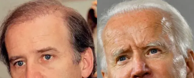 Joe Biden Hair Transplant Featured Image 1