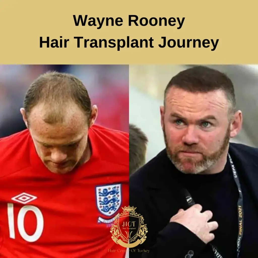 Wayne Rooney Hair Transplant Journey